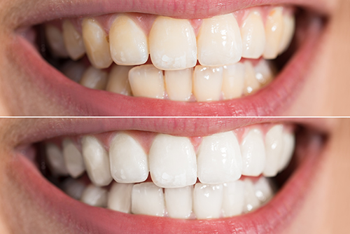 teeth whitening systems